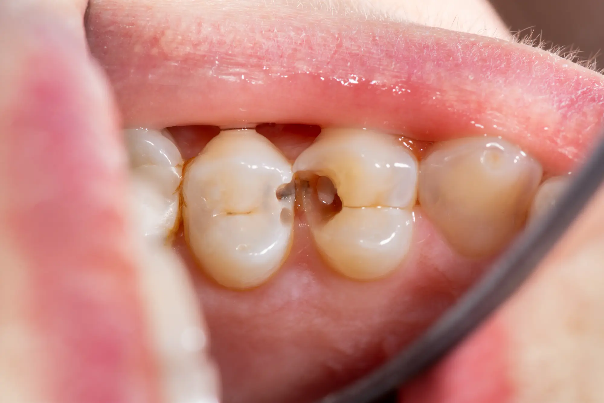 blog-thumb-1